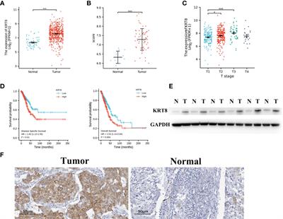 KRT8 Serves as a Novel Biomarker for LUAD and Promotes Metastasis and EMT via NF-κB Signaling